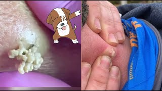 Satisfying Pimple Popping Extractions Watch the Ultimate Dermatology Delight [upl. by Mauchi]