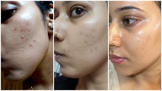 How I am Removing My Pimple Marks amp Acne Scars so Quickly  Simple Affordable Products [upl. by Brentt]