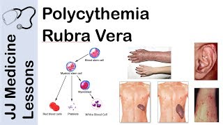 Polycythemia Rubra Vera  Pathophysiology Symptoms Diagnosis and Treatment [upl. by Dorison]