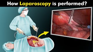 What Happens During Laparoscopy Procedure UrduHindi [upl. by Alf636]