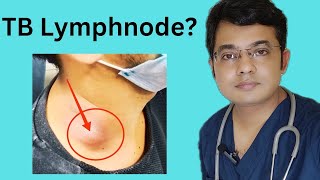 TB Lymphnode Symptoms Diagnosis amp Treatment Tuberculous lymphadeniyis [upl. by Yasmar]