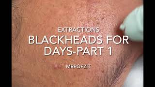 Big Blackheads Extraction from Cheeks  Best Pimple Popping videos [upl. by Steady]