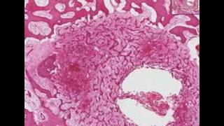 Histopathology BoneOsteoid osteoma [upl. by Feldman794]