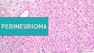 PerineuriomaExplained by a Soft Tissue Pathologist [upl. by Mccomb912]