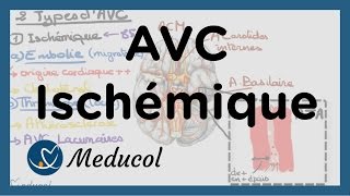 AVC ischémique causes embolie cérébrale AVC thrombose et AVC jonctionnel [upl. by Ssalguod]