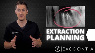 How To Extract Teeth Successfully Every Time  OnlineExodontiacom [upl. by Ail]