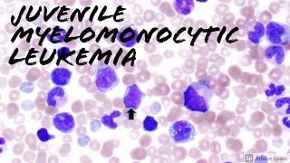 Juvenile Myelomonocytic Leukemia JMML Peripheral Blood Smear 2 year old Hematology amp Hemepath [upl. by Adnalu242]