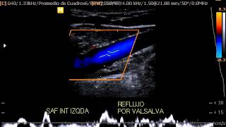 ACCUVIX V20 ECO DOPPLER VENOSO DE MIEMBROS INFERIORES [upl. by Bartley]