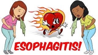 Esophagitis [upl. by Ariamoy]