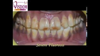 Treatment of Severe Fluorosis [upl. by Agnimod]