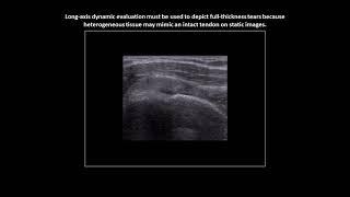 Fullthickness tear of the supraspinatus tendon on shoulder ultrasound case 3 [upl. by Lamej]