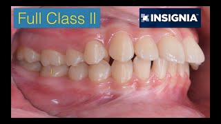 Treatment of Bimaxillary Protrusion with Insignia｜【Chris Chang Ortho】CC730 [upl. by Iman]