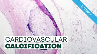 Vitamin K2 and Cardiovascular Calcification [upl. by Imotih]