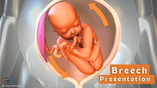 Breech presentation  Feet down baby position [upl. by Peta867]