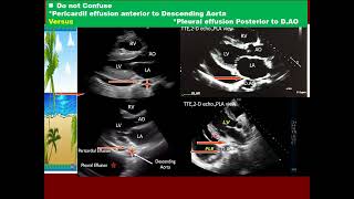 1 Test your skill pericardial vs pleural effusion TR severity [upl. by Vicky]