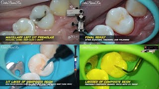 occlusal cavity restoration composite resin grandioso heavy flow amaris voco premolar [upl. by Ysac]