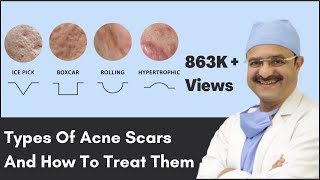 Types Of Acne Scars And How To Treat Them  ClearSkin Pune  In HINDI [upl. by Blumenfeld]