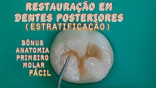 Restauração em Dentes Posteriores ESTRATIFICAÇÃO  BONUSAnatomia Primeiro molar Fácil [upl. by Claresta]