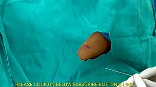 Lumbar Puncture Procedure in Hindi spinal tap diagnostic Procedure [upl. by Akaya322]