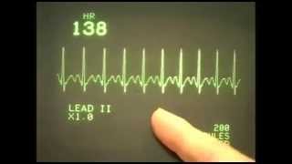 EKC ECG rhythms 1 Normal range of rhythms [upl. by Lachish]