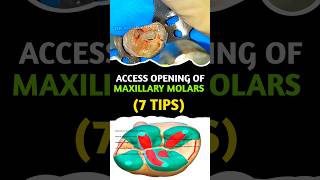 How to do access opening in Maxillary Molars EASY WAY rootcanaltreatment rootcanal shorts [upl. by Labaw]