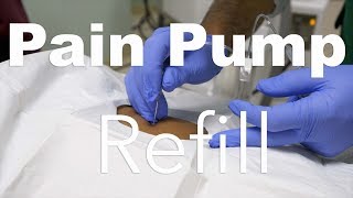 Behind The Scenes Intrathecal Pain Pump Refill [upl. by Finnegan]