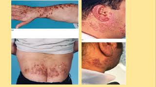 Lecture115 Cutaneous Photosensitivity diseases PartII Rooks chapter 127 [upl. by Aibsel]