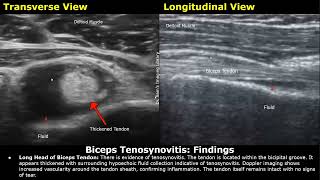 Shoulder Ultrasound Reporting  Supraspinatus Tendinosis Tears Biceps Tendon Joint Effusions USG [upl. by Alisha]