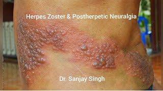 Herpes Zoster amp Postherpetic Neuralgia herpesawareness herpesvirus herpeszoster chickenpox [upl. by Meijer143]