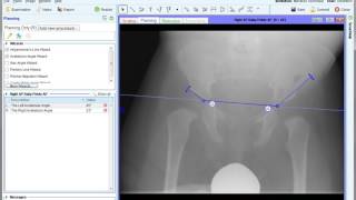 Developmental Dysplasia of the Infant Hip  DDH  Materialise OrthoView [upl. by Hoon]