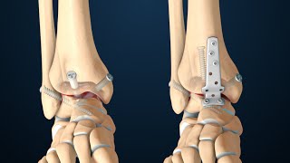 Arthrodesis  Anterior Ankle Fusion Surgery  Nucleus Health [upl. by Wernda]