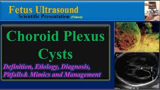 Fetus Ultrasound Choroid Plexus Cyst [upl. by Atinnod291]