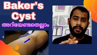 Bakers Cyst MalayalamSymptoms causesTreatment [upl. by Brew]