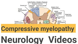 Compressive myelopathy  Neurology videos learn by seeing [upl. by Blunt]