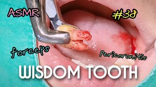 ASMR Wisdom Tooth Extraction in 17 Seconds [upl. by Eshman]