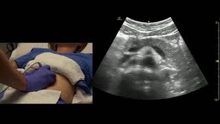 Abdominal Aorta and Pancreas Ultrasound Scanning Technique [upl. by Ldnek]