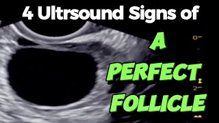 A Perfect Follicle  4 Ultrasound Signs  of Good Follicle for Easy Conceiving [upl. by Mcquillin]