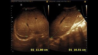 Ultrasound cases 405 of 2000  Right Sided Pleural effusion Mild Hepatomegaly Mild Ascites [upl. by Ellertnom]