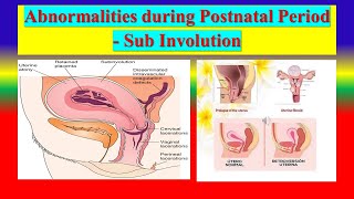 SUB INVOLUTION  DefinitionDiagnosisManagement  Abnormalities during Postnatal Period  OBG [upl. by Namie]