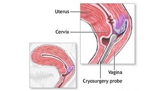 Cryosurgery  NYS Approved  Brooklyn Abortion Clinic [upl. by Wirth]