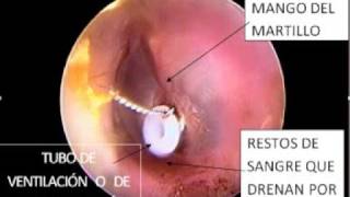 Tympanostomy Ear tubes [upl. by Llywellyn]