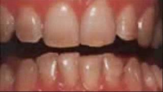 Dental Bleeching  White Teeth  beautiful results in Belgium [upl. by Coumas]