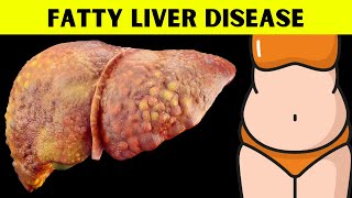 The Ultimate Guide to Understanding Fatty Liver Disease Everything You Should Know About Fatty Liver [upl. by Iila]