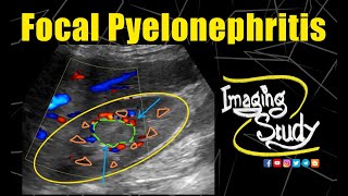 Focal Pyelonephritis in Pregnancy  Ultrasound  CT  Case 192 [upl. by Fink]