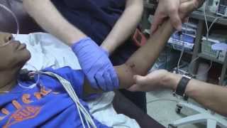 Posterior Elbow Dislocation Reduction [upl. by Yenttihw]