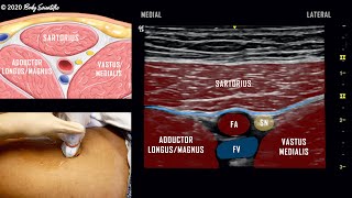 Adductor Canal Block Saphenous Nerve  UltrasoundGuided Demonstration [upl. by Audrit]