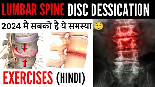 Disc desiccation with diffuse disc bulge  L4L5 L5S1 Low back pain पैरो मै दर्द  सुन्नपन जलन [upl. by Eisenstark97]