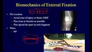 Orthopaedic Implants 2  External Fixation [upl. by Nhor352]