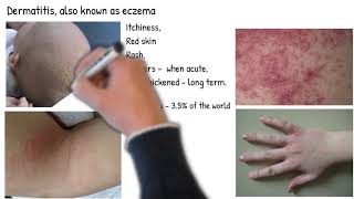 Dermatitis vs Eczema are they same Types of dermatitis symptoms prognosis and treatment [upl. by Ole448]