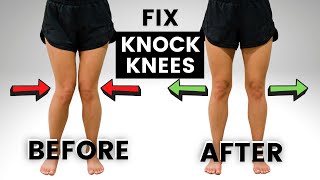 How to Fix KNOCK KNEES without SURGERY [upl. by Ayak]